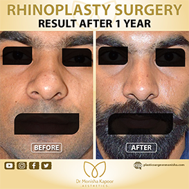 rhinoplasty-img15